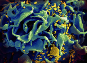An HIV-infected human T cell under the microscope.